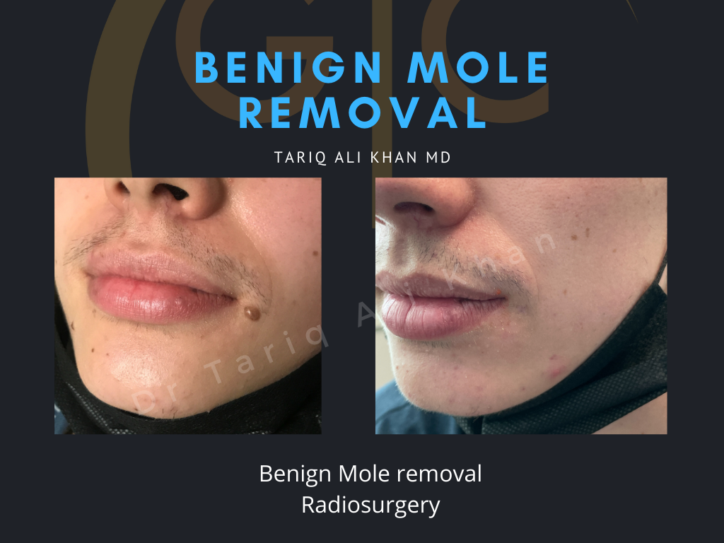 Gentle Care Laser Tustin Before and After picture - Mole Removal